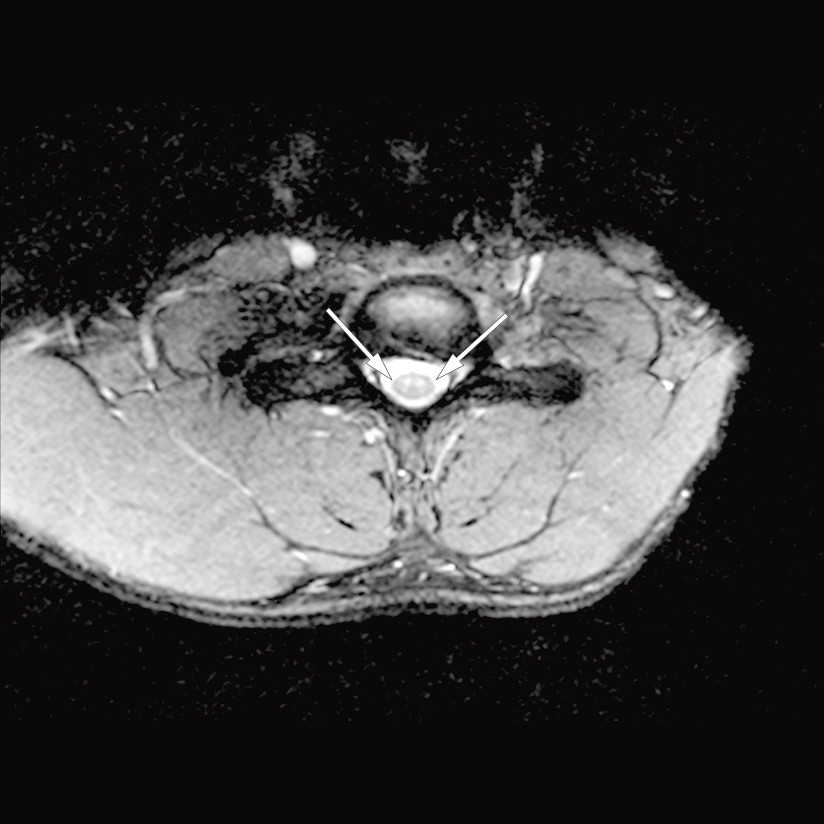 Figure 2 Axial T2 image at level C6. Increased signal corresponding to the anterior horn bilaterally, but normal signal in&hellip;