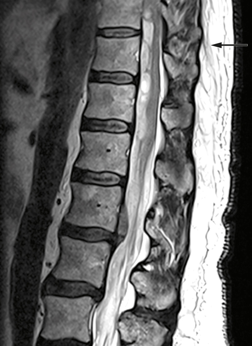 Figure 1 Preoperative MRI: Intraspinal subdural haematoma at levels Th9-L1 and dislocation of the spinal cord and medullary&hellip;