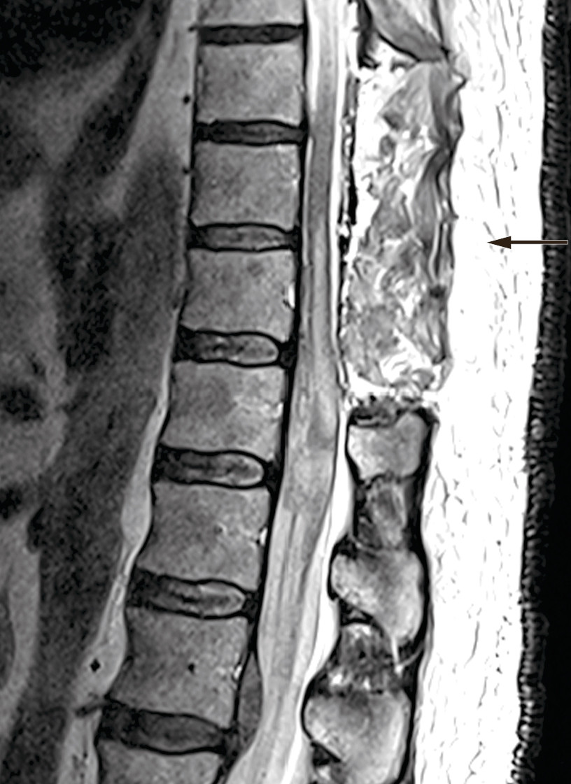 Figure 2 Postoperative MRI: Laminectomy performed at levels Th9&ndash;11. MRI shows reduction in volume of the subdural haematoma&hellip;