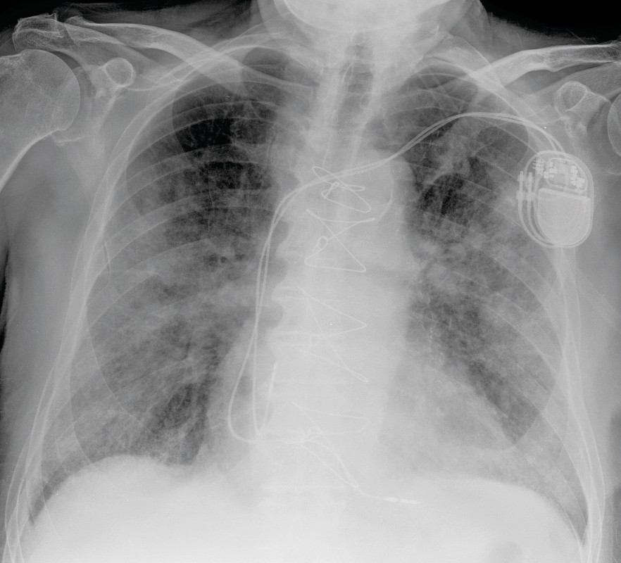 Figure 2 Chest X-ray frontal image taken on day 7 shows extensive opacities bilaterally, both patchy and consolidating. The&hellip;