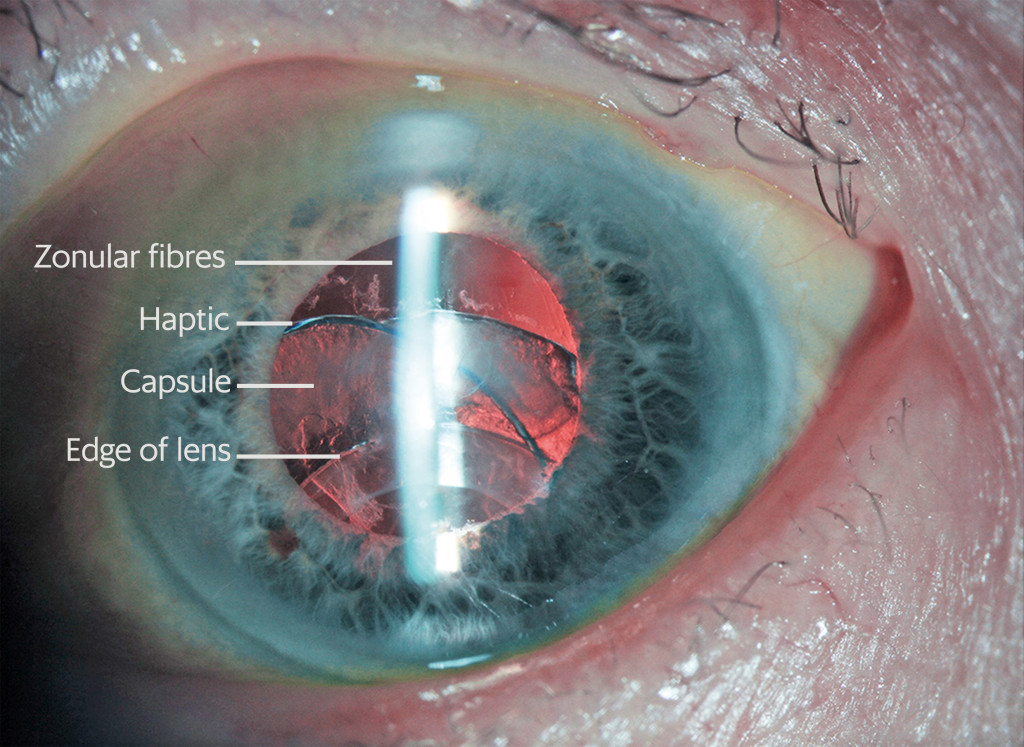 Figure 1 The intraocular lens with surrounding capsule dislocated downwards.