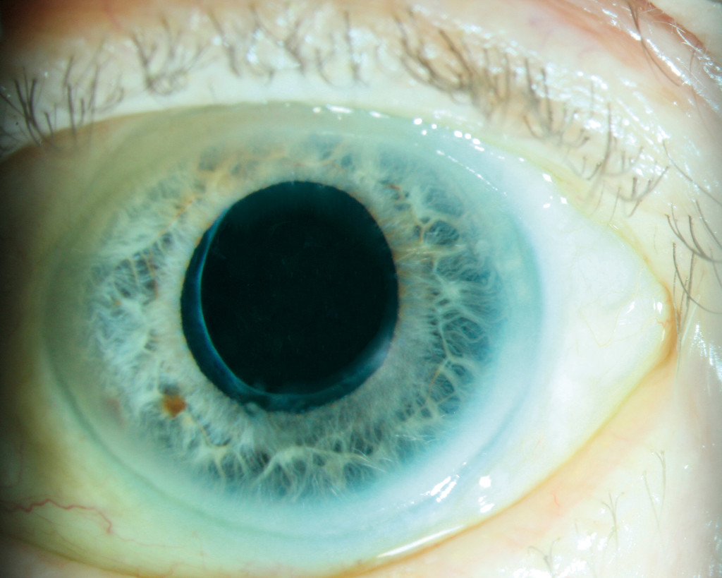 Figure 2 The eye with centred lens complex six weeks after the operation.