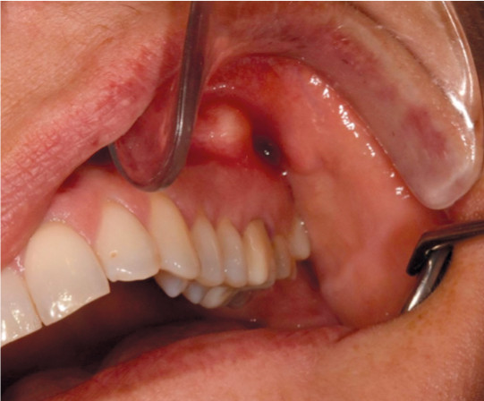 Figure 1 Periapical abscess from upper left molar.