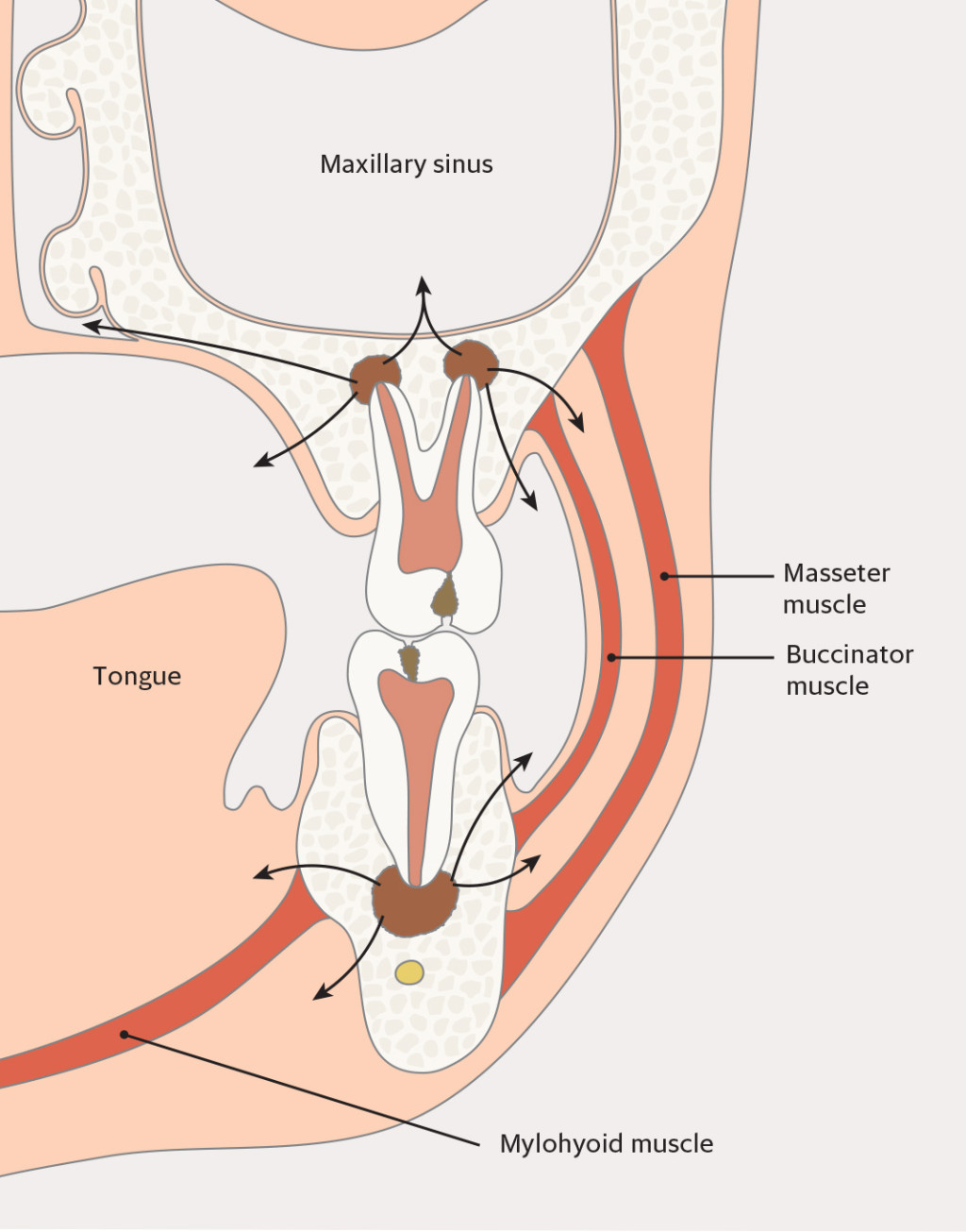 Figure 2 Possible routes of spread of periapical infections from upper and lower molars.