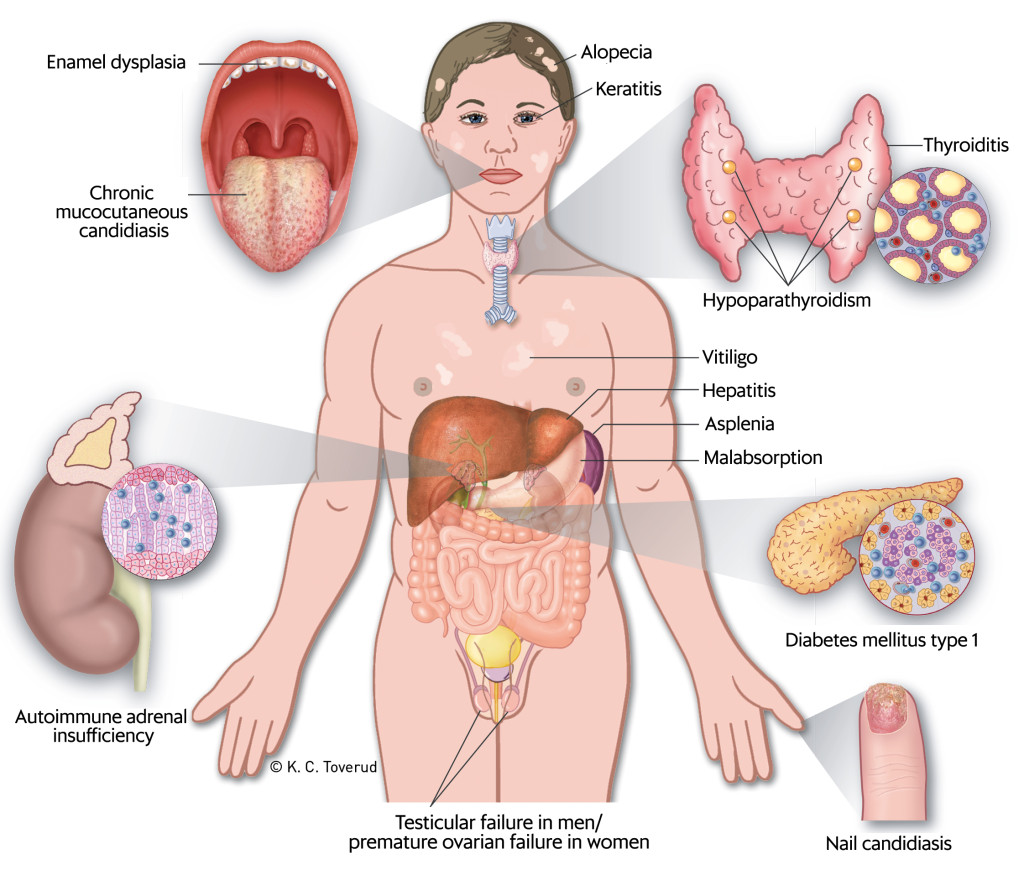 Figure 1 Clinical manifestations that may occur in cases of autoimmune polyendocrine syndrome type 1 (APS-1). The figure has&hellip;