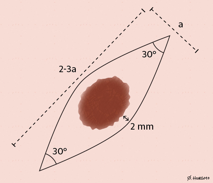 Figure 2 Fusiform markup with macroscopic free margin (2 mm). Ratio 3:1 and acute 30o angles. The 3:1 ratio is not absolute,&hellip;