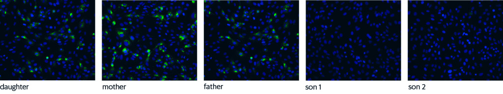 Figure 2 Immunofluorescence staining (IF) of SARS-CoV-2-infected cells with serum from all five family members. SARS-CoV-2&hellip;