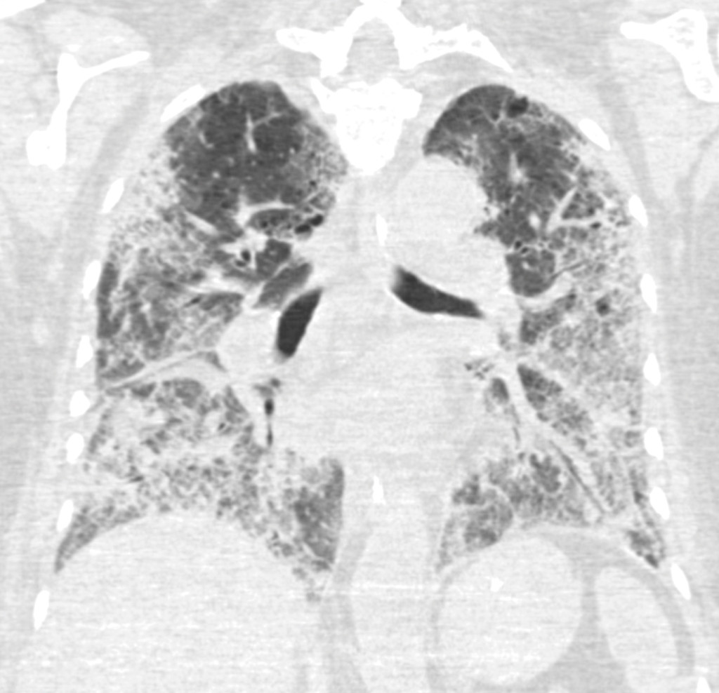 Figure 2 Frontal CT thorax section taken 28 days after onset of symptoms, 17 days after hospitalisation and 14 days after&hellip;