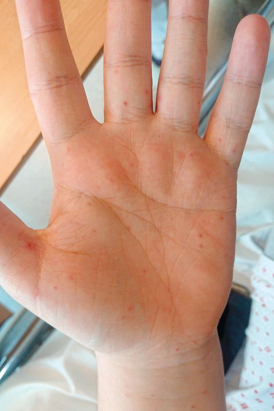 Figure 1 Exanthema on the patient's left palm.