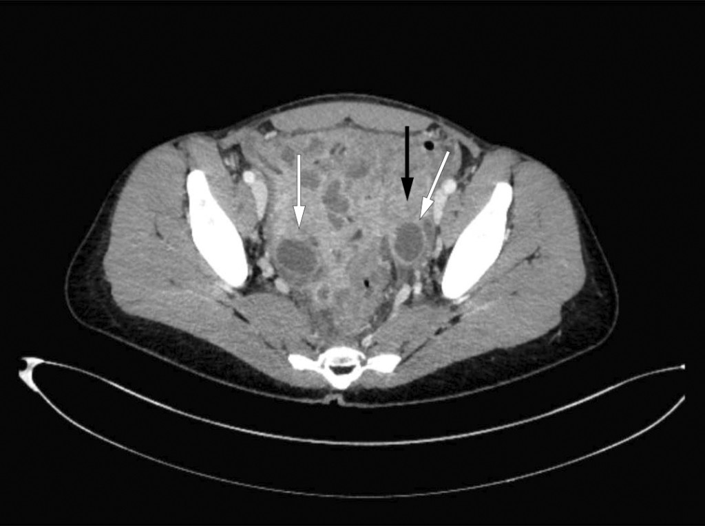 Figure 1 CT scan showed marked inflammation in the pelvis with enlarged, fluid-filled ovaries (white arrows) and thickening&hellip;