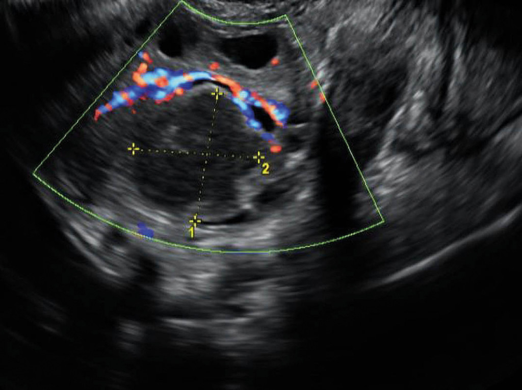 Figure 2 Vaginal ultrasound showed an ovarian cyst measuring 2.5 &times; 2.4 cm, with hypoechoic content.