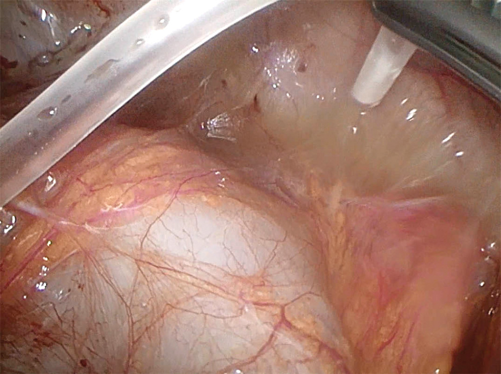 Figure 3 Image from laparoscopy. Free-flowing pus upon suction.
