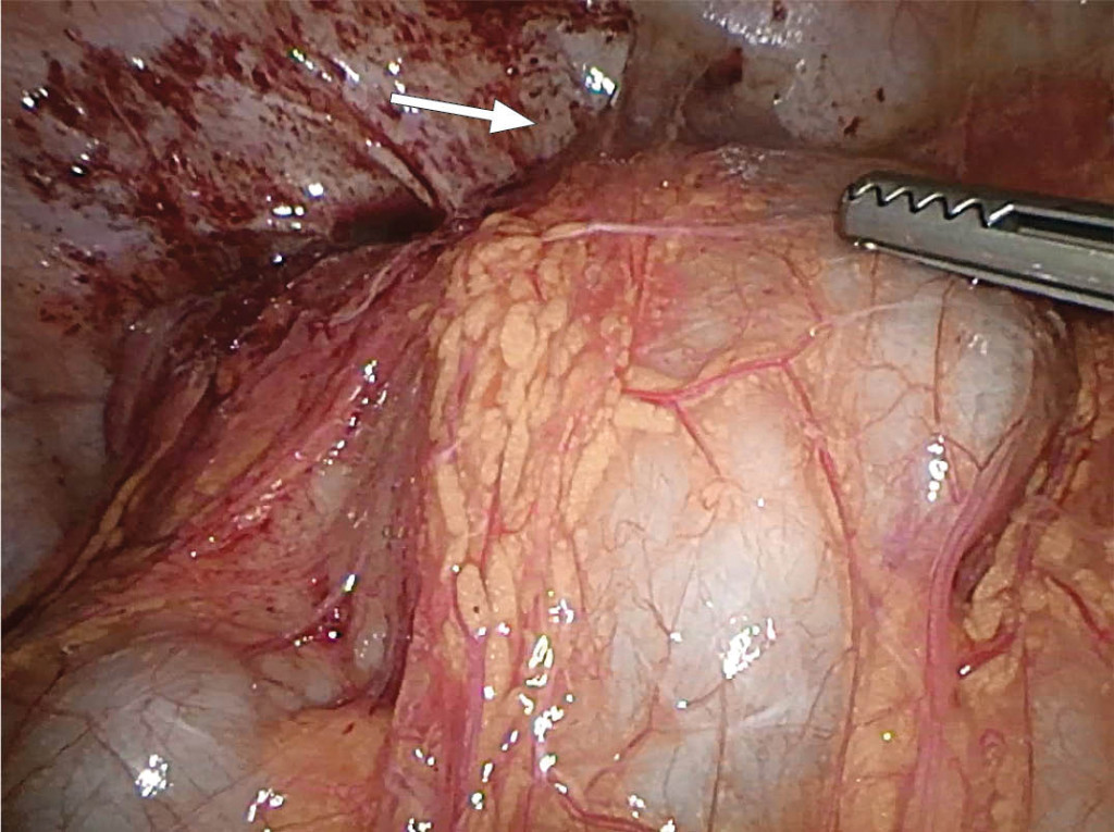 Figure 4 Image from laparoscopy. Lack of access to the lesser pelvis owing to adhesion between the intestines and the&hellip;