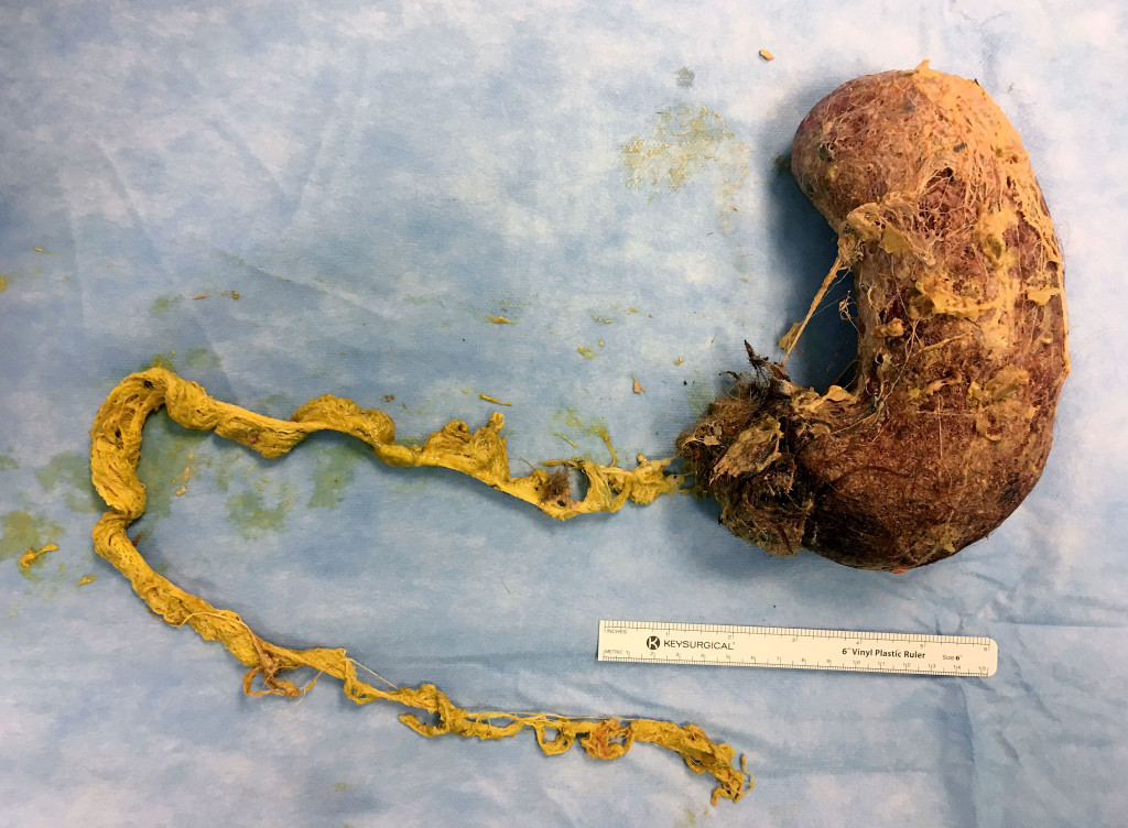 Figure 2 The trichobezoar shaped like the stomach, with an extension about 60 cm long
