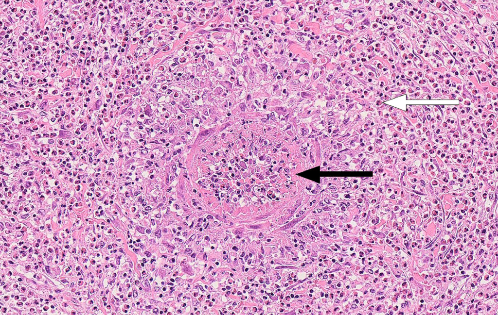 Figure 2 Small liver artery with vasculitis and abundant infiltration of eosinophilic granulocytes. Haematoxylin-eosin&hellip;