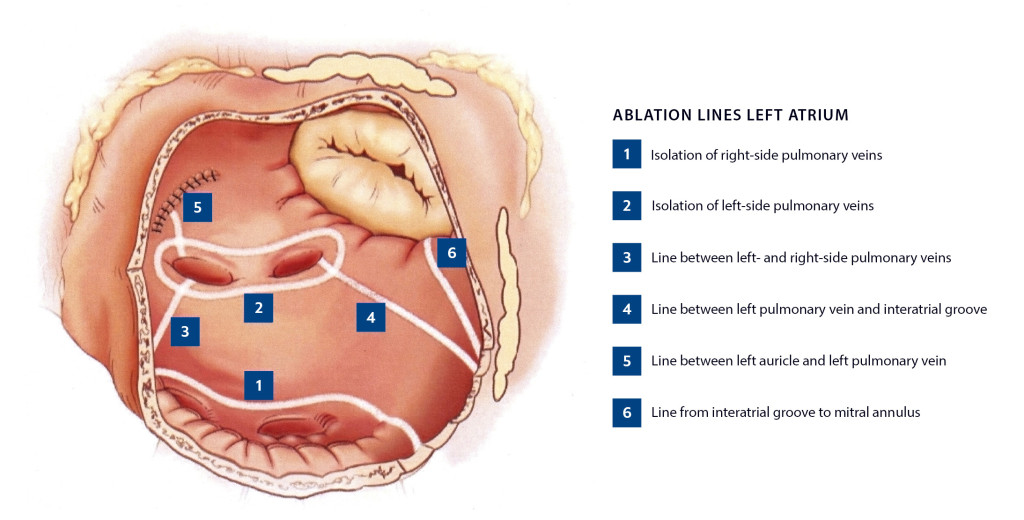 Figure 1 Ablation lines according to the CURE-AF protocol generated with radiofrequency ablation. The figure is reproduced&hellip;