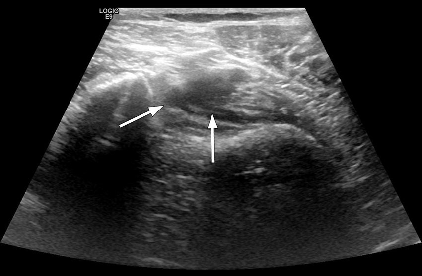 Figure 1 Ultrasound image of right lower extremity, patient examined with legs hanging over the edge of the bed. Distal&hellip;
