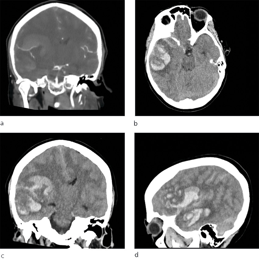 Figure 1 CT of patient's head at a local hospital shows major parenchymal bleeding in the right hemisphere with breakthrough&hellip;