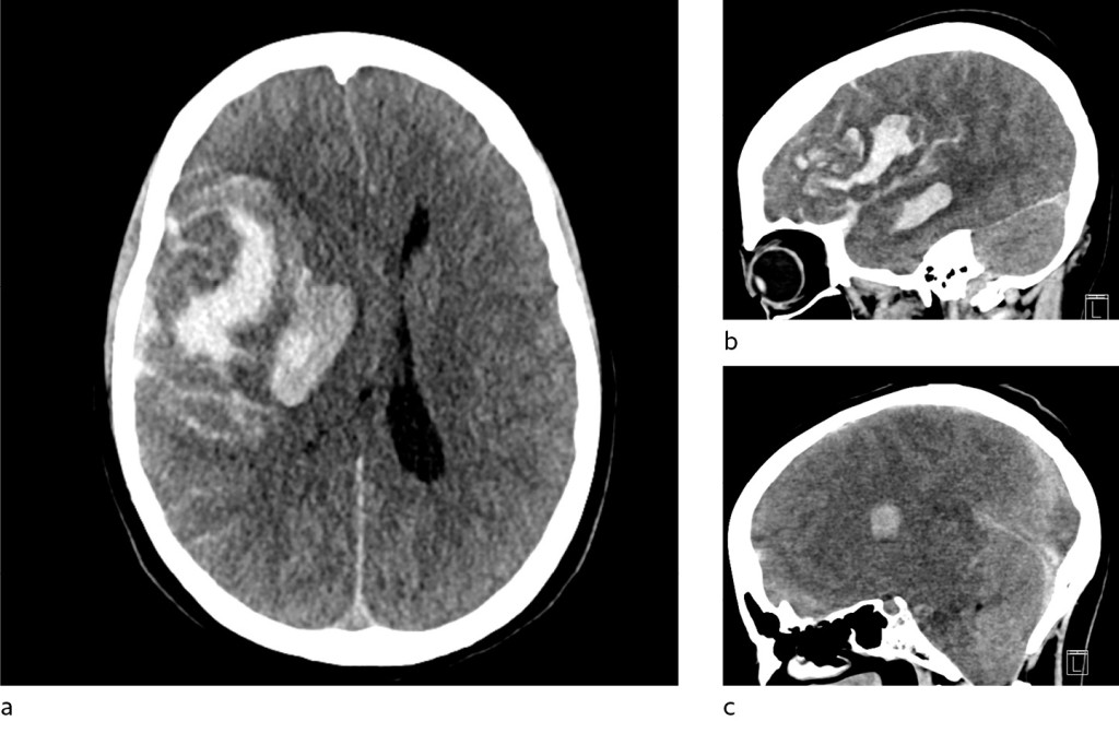 Figure 2 CT of the patient's head at the university hospital showed increased haematoma, a) axially, b) sagittally and c)&hellip;