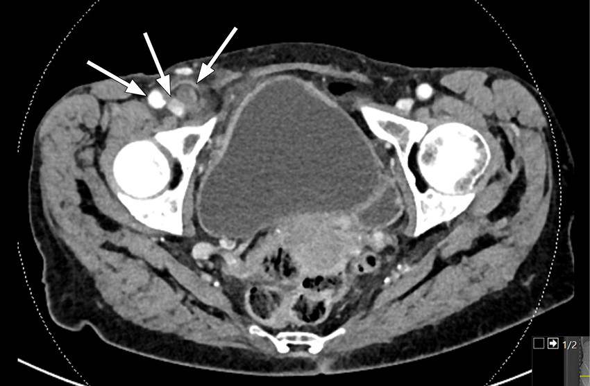 Figure 1 Axial CT  scan showing a superficial tubular structure in the right fossa with adjacent adipose tissue remodelling,&hellip;