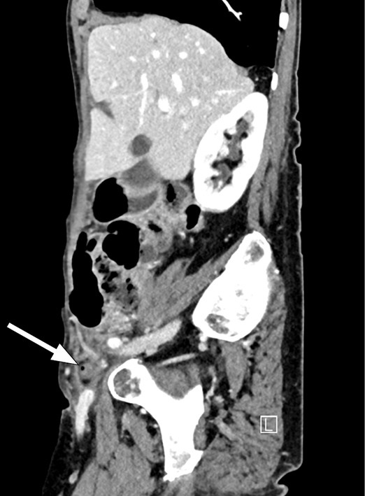 Figure 2 Sagittal CT  scan. The arrow shows a mass in the inguinal canal with a small gas bubble.