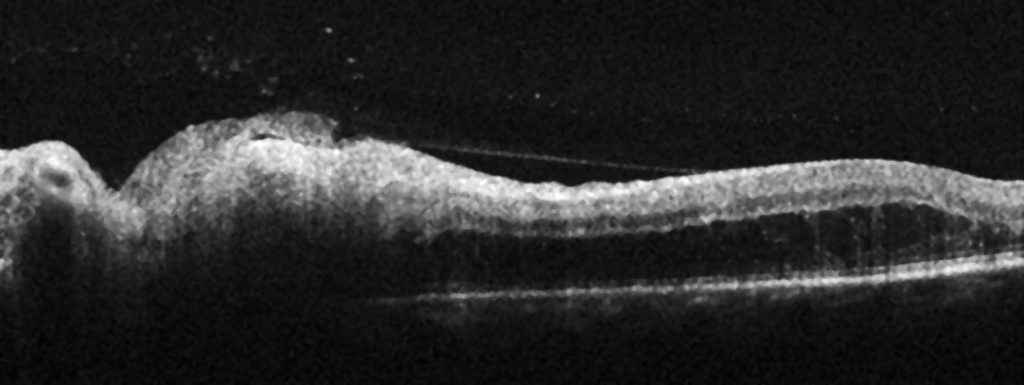 Figure 2 Radial OCT through the optic disc (to the left) and nasal macula (fovea to the right). Thickening of the inner&hellip;