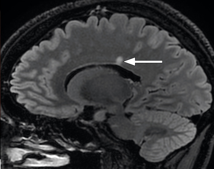 Figure 3 MRI of the head with a FLAIR (fluid-attenuated inversion recovery) sequence in the sagittal plane shows a&hellip;