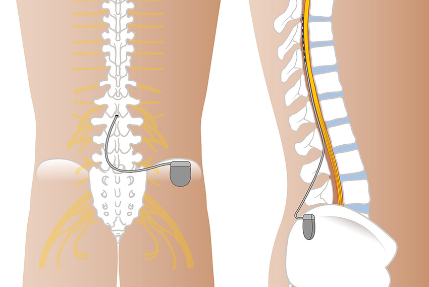 Figure 1 Spinal cord stimulator system with epidural electrode and subcutaneous pulse generator. Illustration: &Oslash;ystein&hellip;
