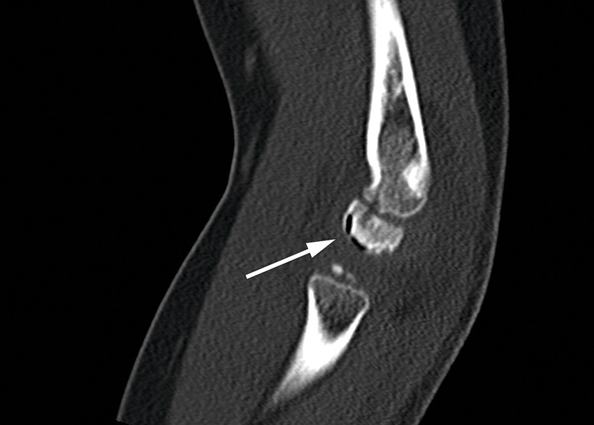 CT scan showing the vacuum phenomenon (white arrow).