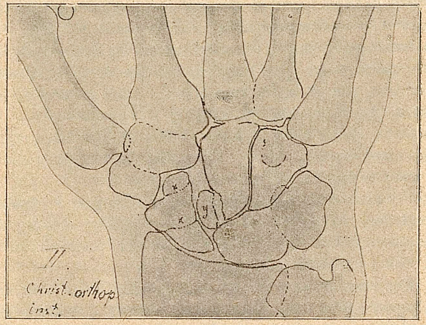 Fig. II Mand, 36 aar. Faldt sommeren 1900. &laquo;Klaskede&raquo; venstre haand i bakken. Betydelig h&aelig;velse og smerte. Ingen s&aelig;rlig&hellip;