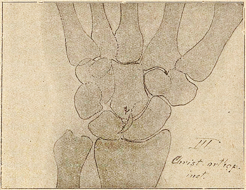 Fig. III Mand, 17 aar. Faldt paa ski i februar 1900, slog h&oslash;ire haand. Betydelig h&aelig;velse og smerter. 17de oktober 1900&hellip;