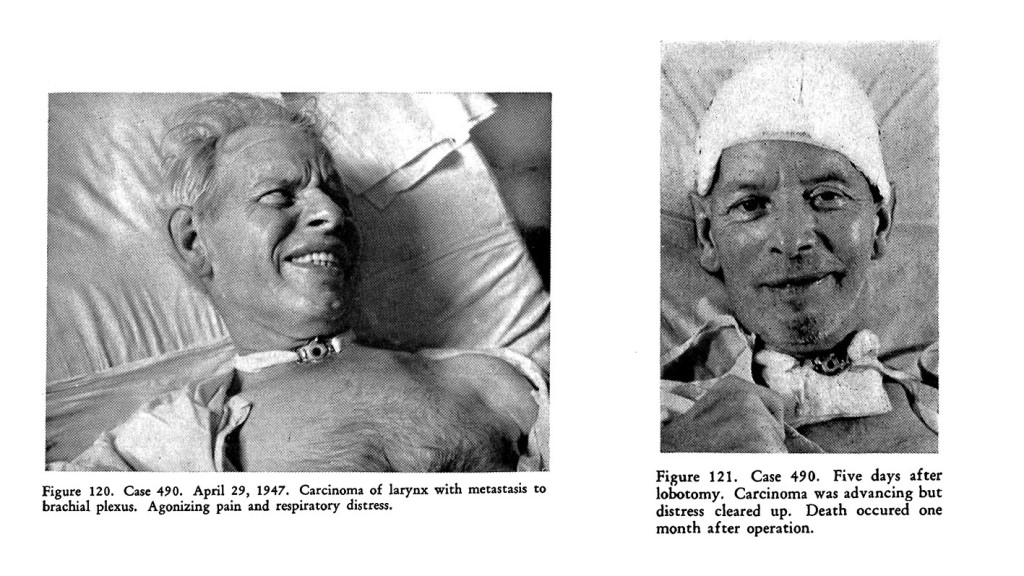 Figur 4 Lobotomi brukt som palliasjon, &laquo;Psychosurgery&raquo; av Freeman and Watts, 1950 (2). Faksimile