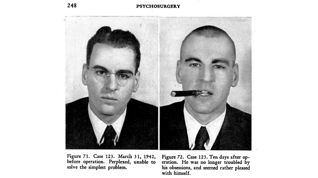 Figure 3 Typical case notes in the book 'Psychosurgery' by Freeman and Watts, 1950 (2). Facsimile