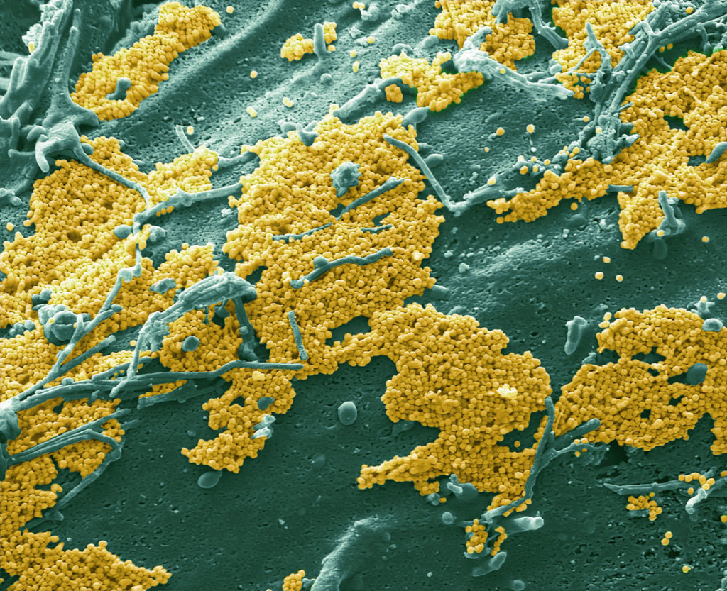 Farget SEM-bilde (sveipelektronmikroskop) av menneskeceller infisert med influensavirus. Illustrasjonsfoto: Science Photo&hellip;
