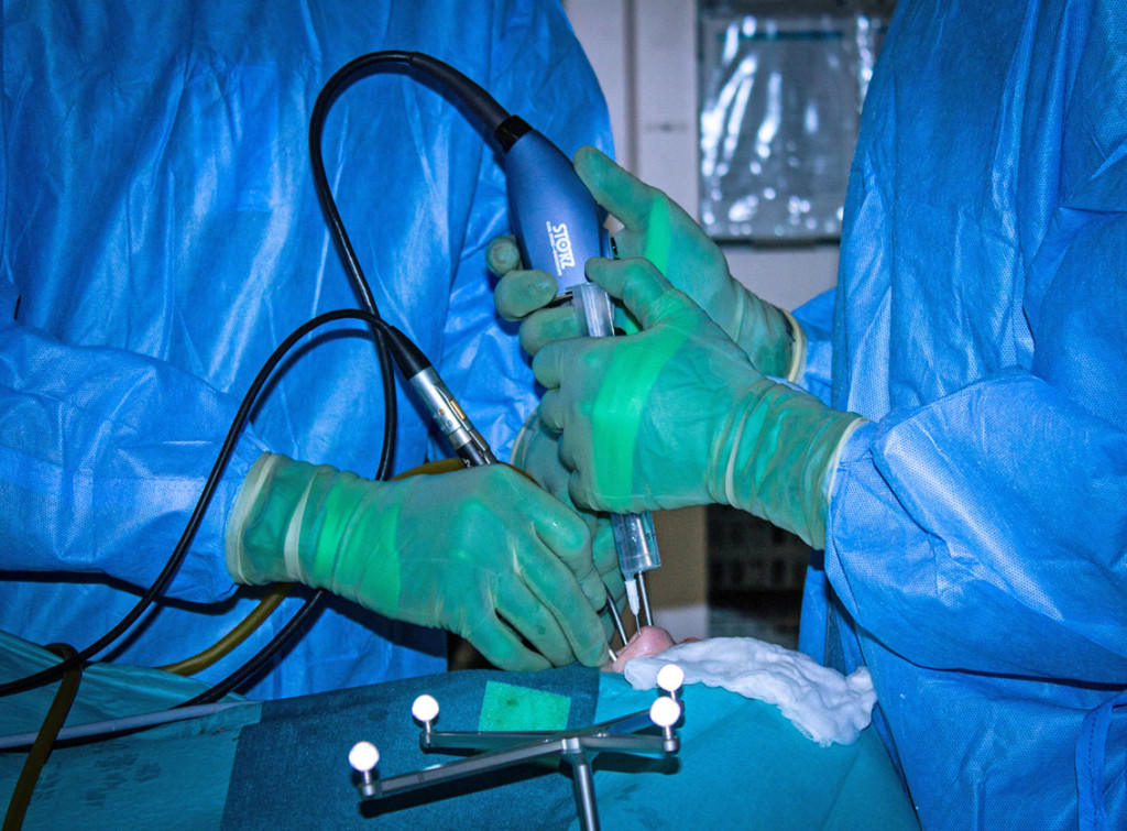 Figure 3 Endoscopic four-hands technique with two surgeons working together. One uses both hands to dissect, the other&hellip;