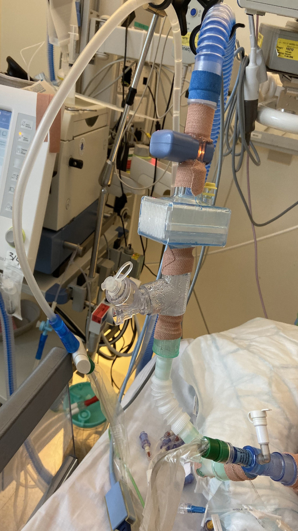 Figure 1 Taping of ventilator connections to prevent the spread of aerosols in the room in the event of accidental&hellip;
