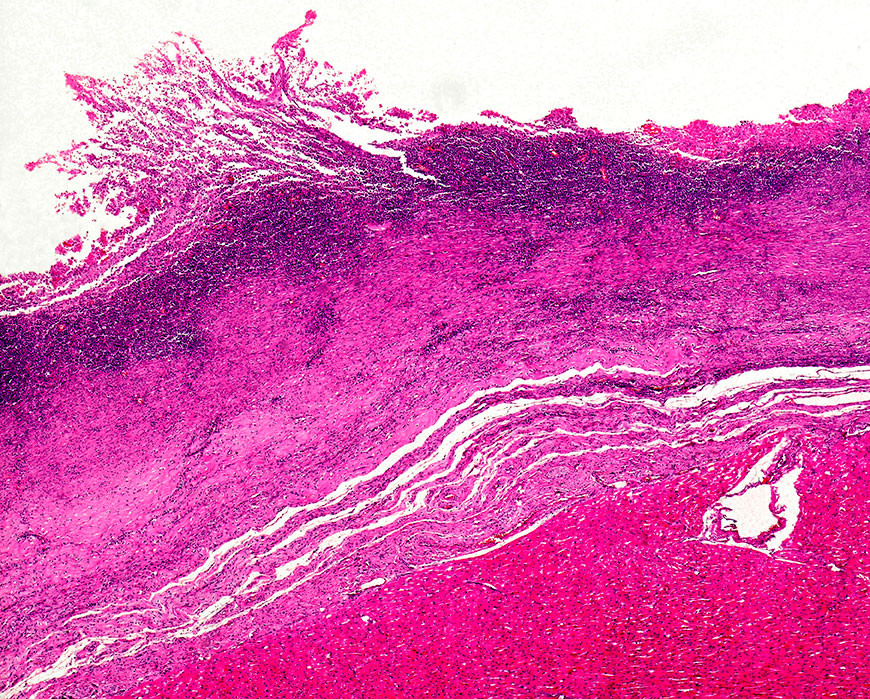 Kardiomyopati vist ved lysmikrografi av hjertemuskel. Foto: Science Photo Library / NTB