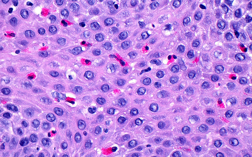 Lysmikrografi av spiser&oslash;rsepitel (overflaten) med et stort antall eosinofile hvite blodceller. Foto: Science Photo Library /&hellip;