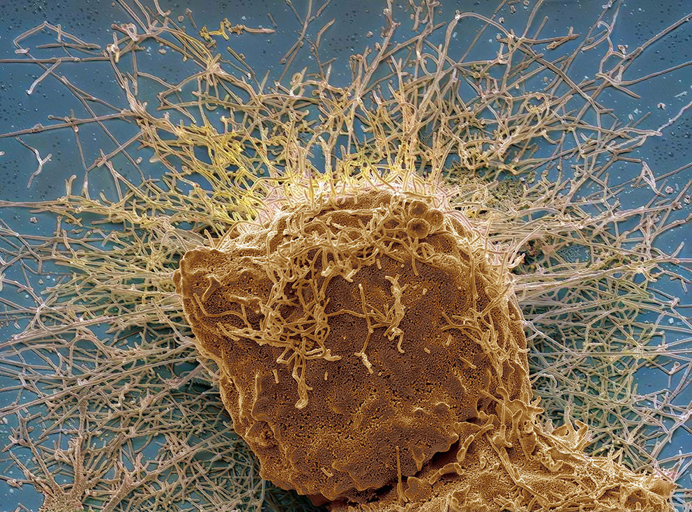 Farget bilde fra skanningelektronmikroskopi (SEM) av en menneskecelle infisert med influensavirus (H3N2). Illustrasjon:&hellip;