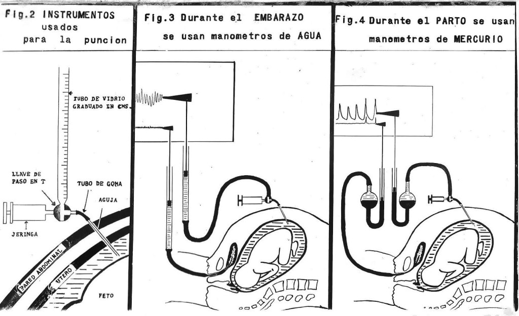 Figur 3 Roberto Caldeyro-Barcias doktorarbeid Contractility of the human uterus during pregnancy and childbirth. Foto:&hellip;