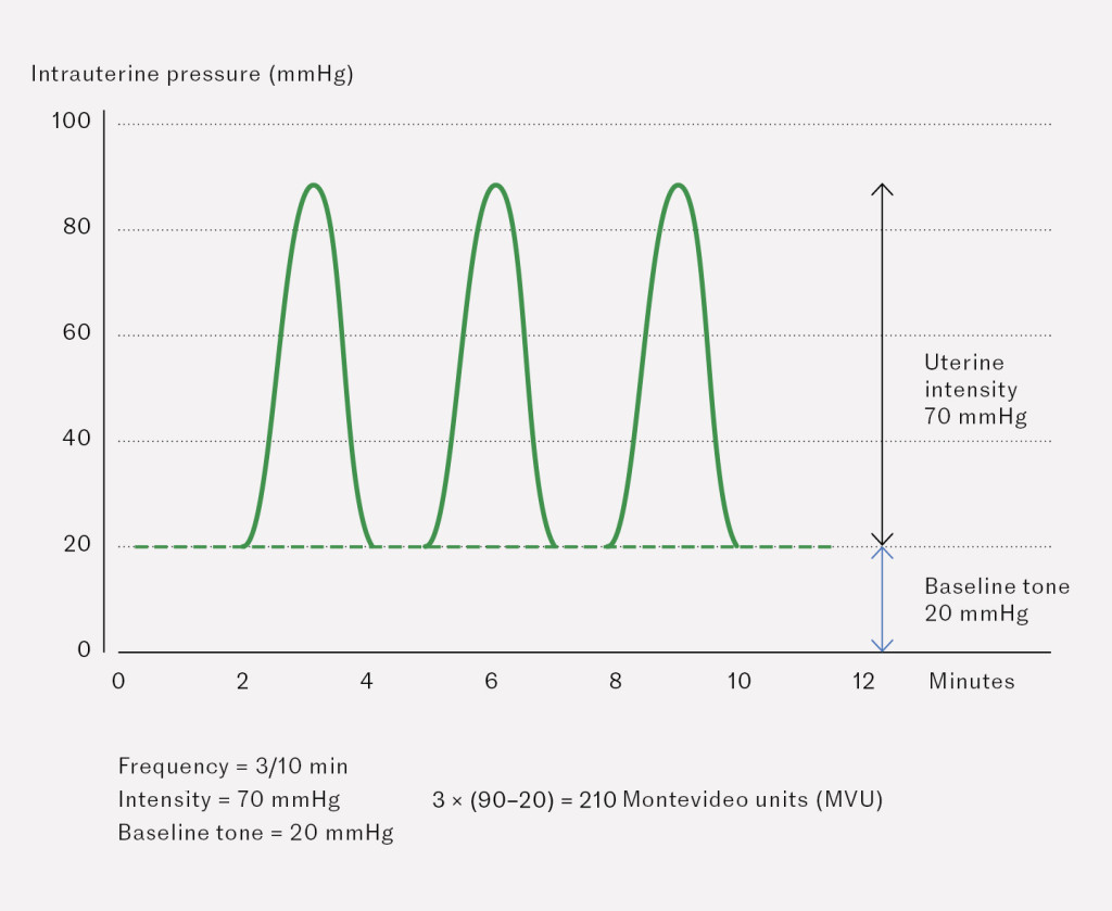 Figure 2 Montevideo units (MVU) are a standard measurement of uterine activity during labour, with a value of 200 MVU&hellip;